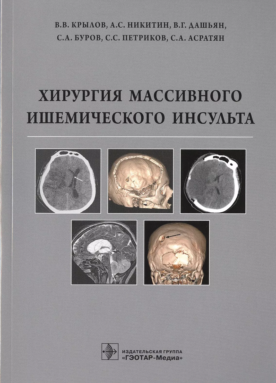 Крылов Владимир Викторович - Хирургия массивного ишемического инсульта