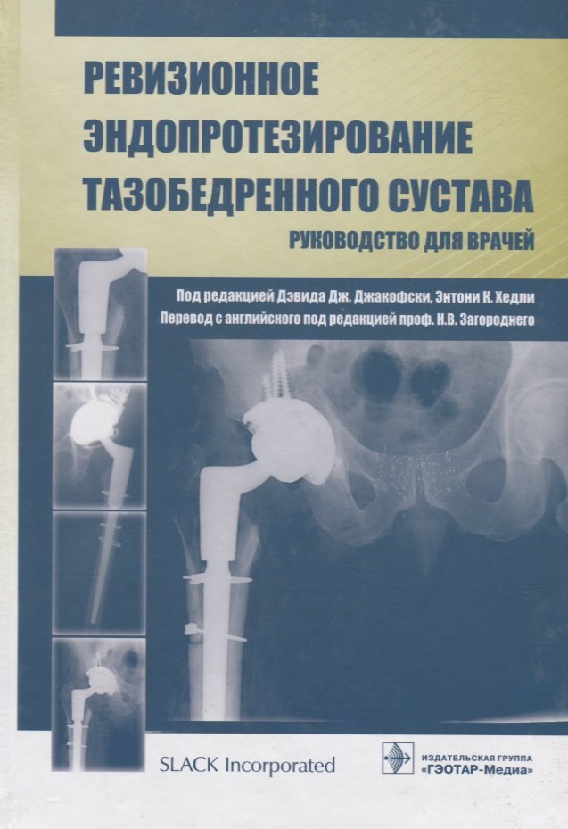 

Ревизионное эндопротезирование тазобедренного сустава: руководство для врачей