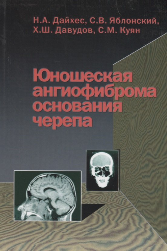 

Юношеская ангиофиброма основания черепа