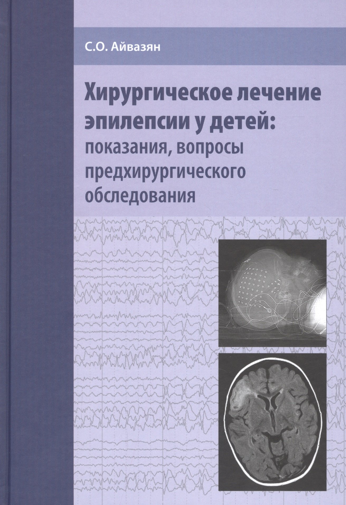 

Хирургическое лечение эпилепсии у детей: показания, вопросы предхирургического обследования