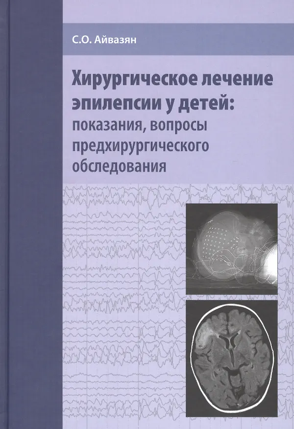 Книга Хирургическое лечение эпилепсии у детей: показания, вопросы предхирургического обследования (Сергей Айвазян) — 1