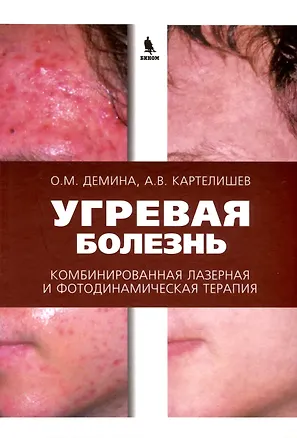 Книга Угревая болезнь. Комбинированная лазерная и фотодинамическая терапия (Анатолий Картелишев, Ольга Демина)