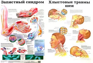 Плакат (мед) Запястный синдром / Хлыстовые травмы шеи (550) (А) — 2091284 — 1