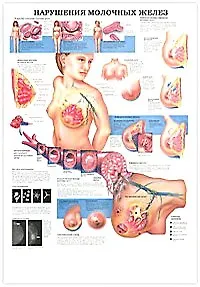 Плакат (70х108) Нарушение молочных желез / Менопауза (А)