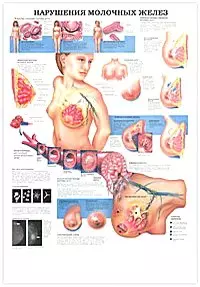 Плакат (70х108) Нарушение молочных желез / Менопауза (А) — 2142113 — 1