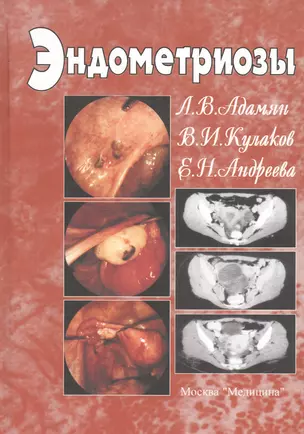 Эндометриозы. Руководство для врачей — 2791619 — 1