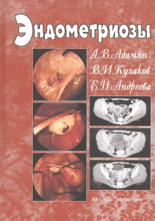 Книга Эндометриозы. Руководство для врачей () — 1