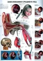 Плакат (70х108) Заболевания среднего уха / Обычная простуда (А) — 2142443 — 1