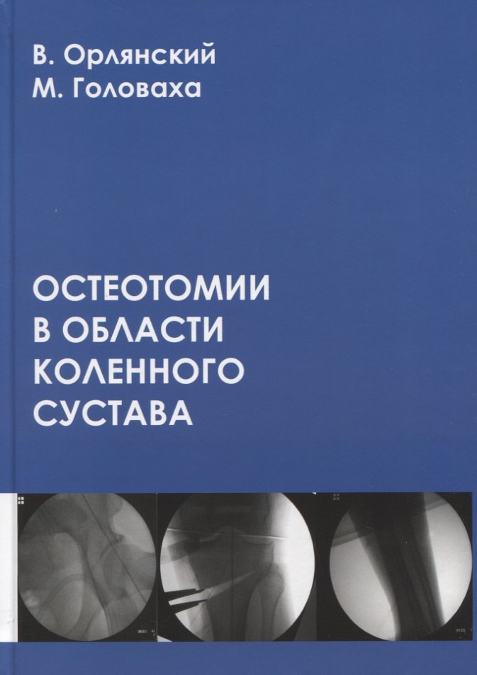 

Остеотомии в области коленного сустава