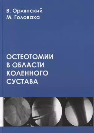 Остеотомии в области коленного сустава — 2864557 — 1