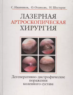 Лазерная артроскопическая хирургия. Дегенеративно-дистрофические поражения коленного сустава — 1889187 — 1