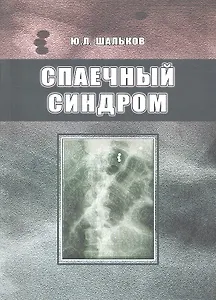 Спаечный синдром.