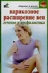 Варикозное расширение вен. Лечение и профилактика