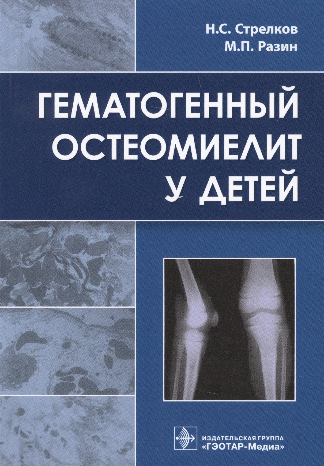 

Гематогенный остеомиелит у детей.
