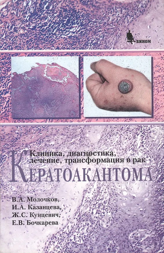Книга Кератоакантома. Клиника, диагностика, лечение, трансформация в рак (Владимир Молочков) — 1