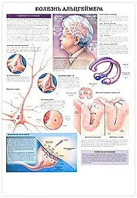 Плакат (70х108) Болезнь Альцгеймера / Эпилепсия (А)