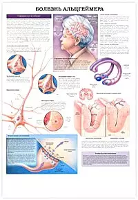 Плакат (70х108) Болезнь Альцгеймера / Эпилепсия (А) — 2142437 — 1