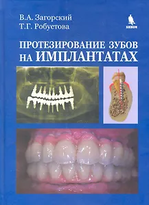 Протезирование зубов на имплантатах.