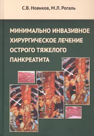 Минимальное инвазивное хирургическое лечение острого тяжелого панкреатита. Монография — 3049107 — 1