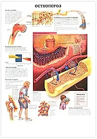 Плакат (70х108) Паркинсонизм / Остеопороз  (А)