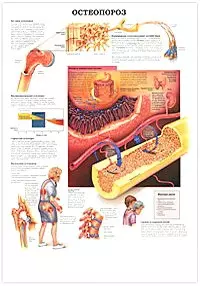 Плакат (70х108) Паркинсонизм / Остеопороз  (А) — 2142107 — 1