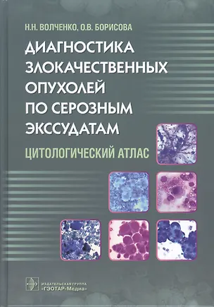 Книга Диагностика злокачественных опухолей по серозным экссудатам. (Надежда Волченко)