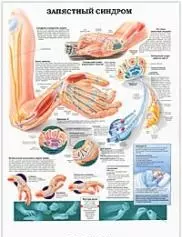 Плакат (70х108) Запястный синдром / Травмы колена (А) — 2142444 — 1