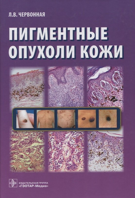 Книга Пигментные опухоли кожи () — 1