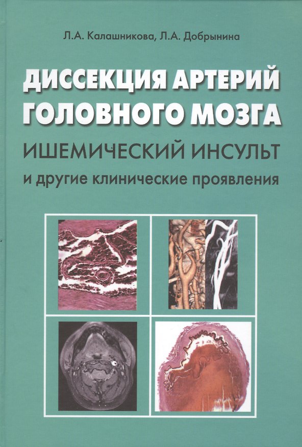 Книга Диссекция артерий головного мозга. Ишемический инсульт и другие клинические проявления () — 1
