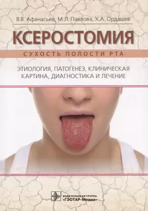 Ксеростомия. Сухость полости рта. Этиология, патогенез, клиническая картина, диагностика и лечение — 2677304 — 1