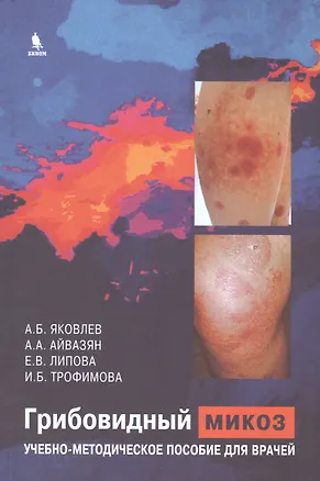 Книга Грибовидный микоз. Учебно-методическое пособие для врачей (Алексей Яковлев)