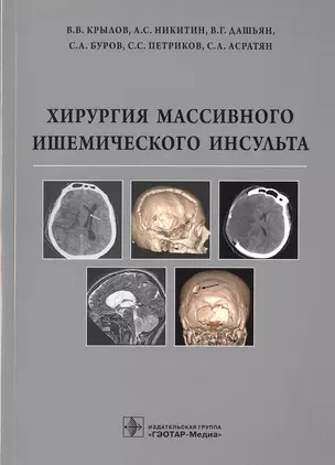 Хирургия массивного ишемического инсульта — 2538413 — 1