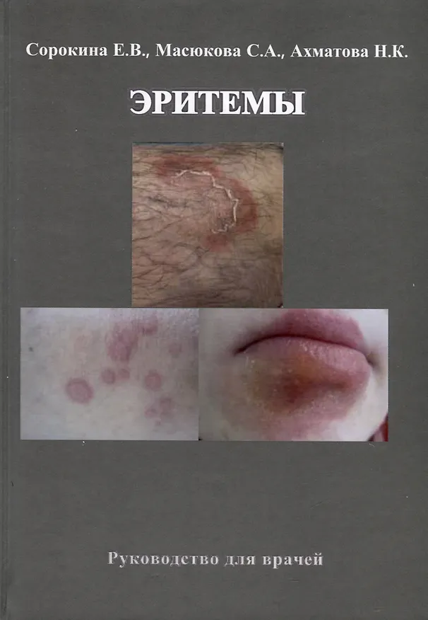 Книга Эритемы. Руководство для врачей (Е. Сорокина, Нэлли Ахматова) — 1