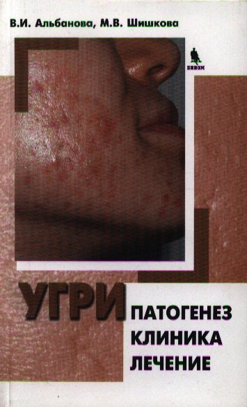 

Угри. Патогенез. Клиника. Лечение