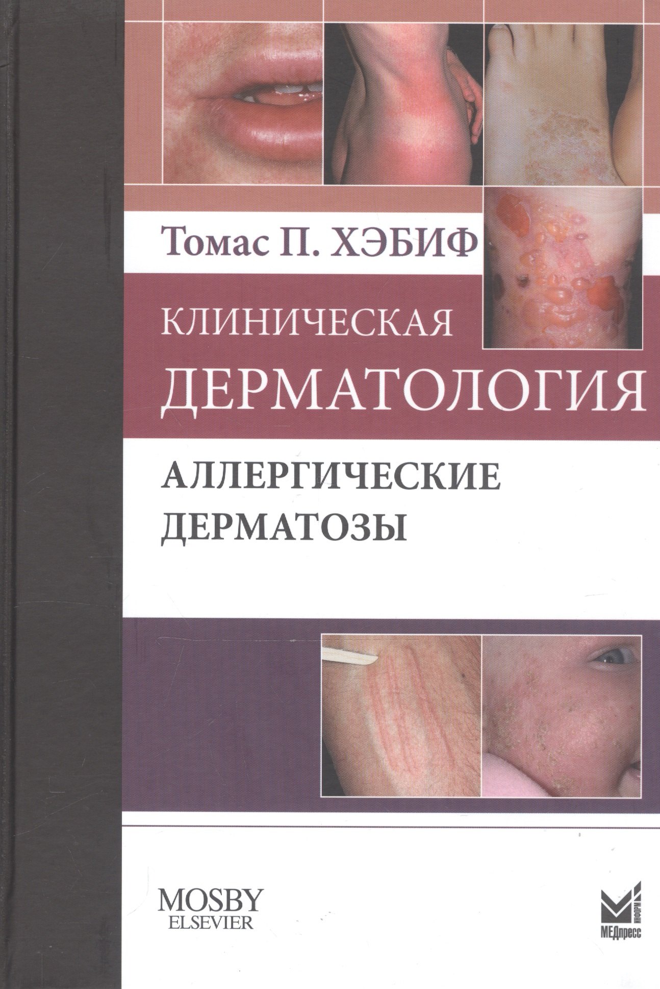 

Клиническая дерматология. Аллергические дерматозы.