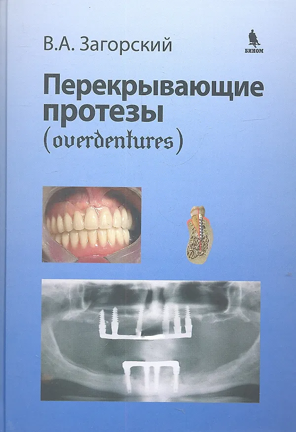 Книга Перекрывающие протезы (overdentures) (Валерий Загорский) — 2