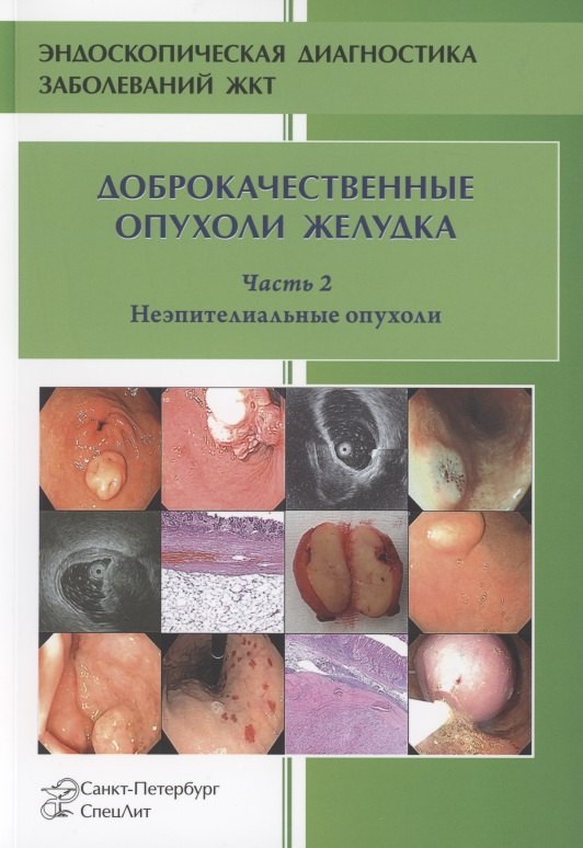 

Доброкачественные опухоли желудка. Часть 2 Неэпителиальные опухоли