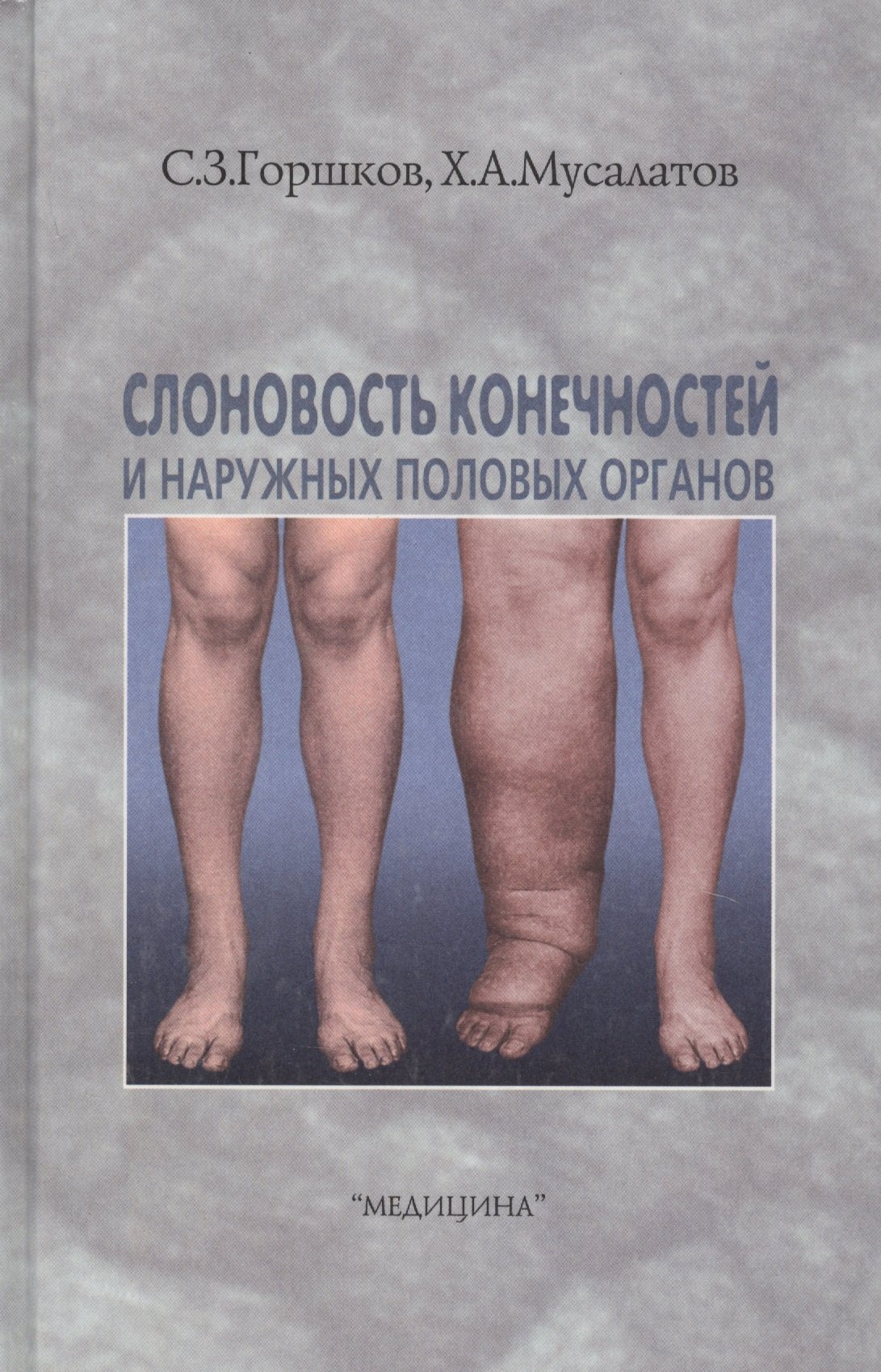 Слоновость конечностей и наружных половых органов
