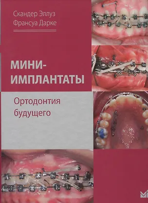 Книга Мини-имплантаты. Ортодонтия будущего. (Скандер Эллуз)