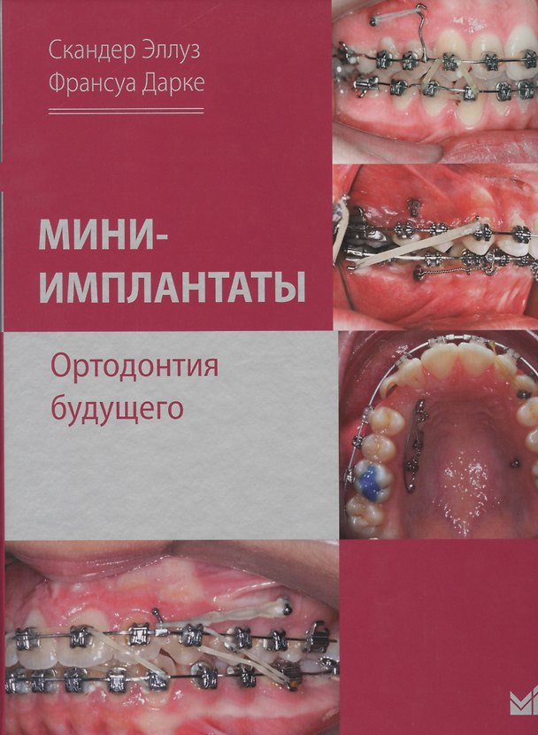 Книга Мини-имплантаты. Ортодонтия будущего. (Скандер Эллуз) — 1