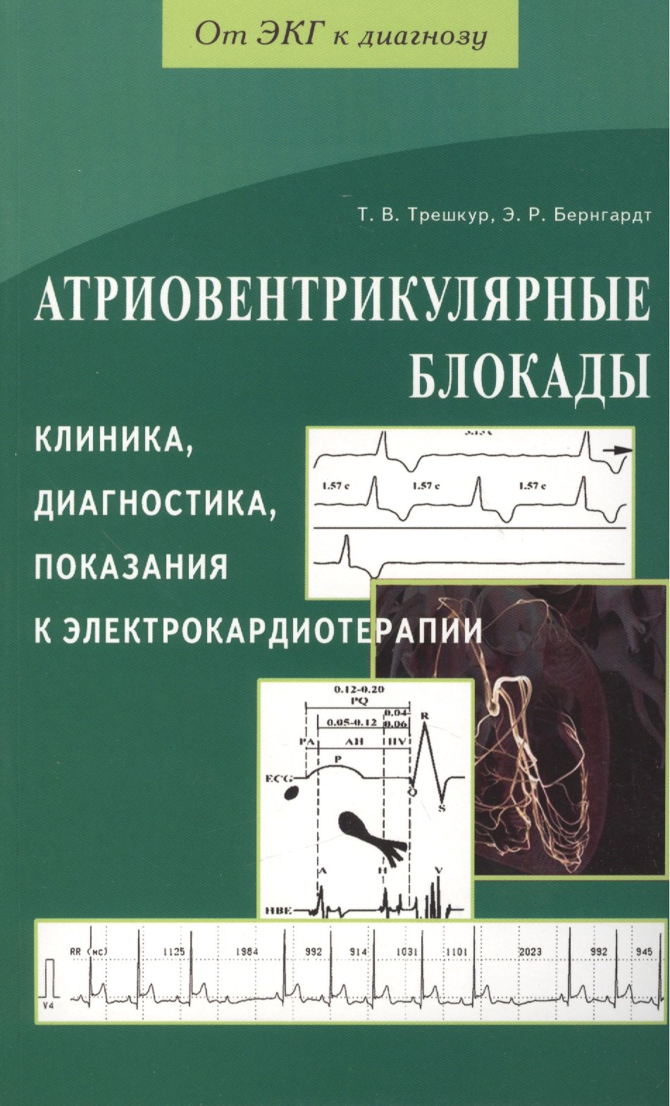 

Атриовентрикулярные блокады. Клиника, диагностика, показания к электрокардиотерапии