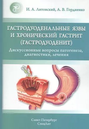 Гастродуоденальные язвы и хронический гастрит (гастродуоденит) — 2580820 — 1