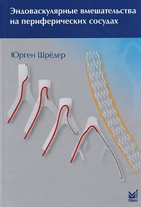 Эндоваскулярные вмешательства на периферических сосудах