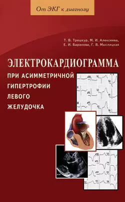 Электрокардиограмма при асимметричной гипертрофии левого желудочка / (мягк) (От ЭКГ к диагнозу). Трешкур Т. и др. (Диля) — 2200352 — 1