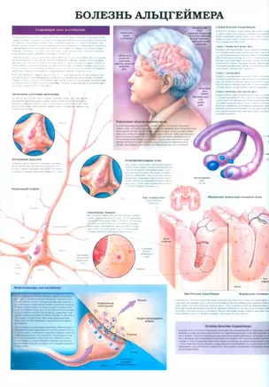 Плакат (мед) Болезнь Альцгеймера / Паркинсонизм (569) (А) — 2091979 — 1